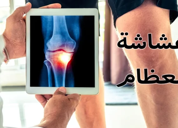 بحث عن هشاشة العظام