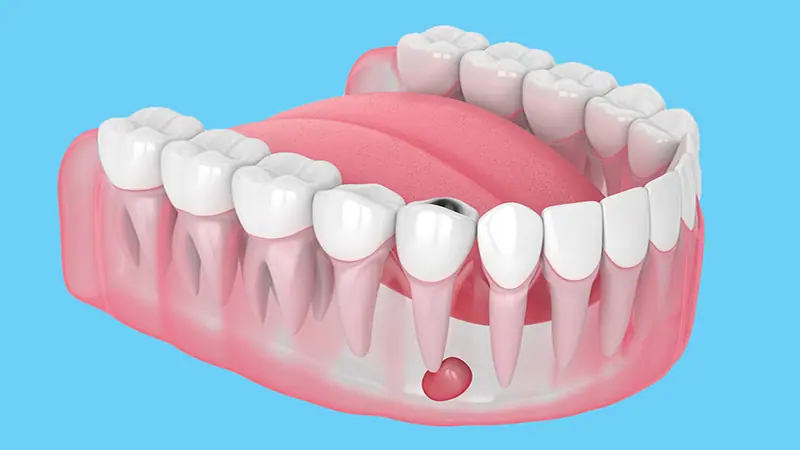 علاج خراج الأسنان وأسبابه وكيفية الوقاية منه